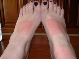 burnt feet