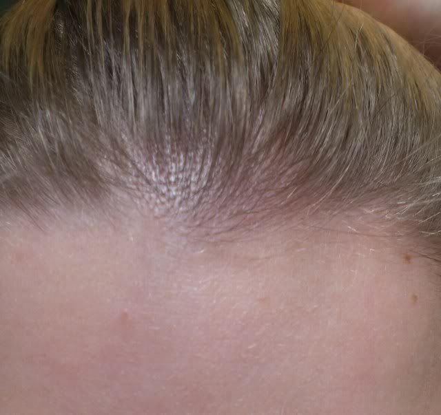 Forum Haarausfall Frauen Forum Frauen Haarausfall Stirn